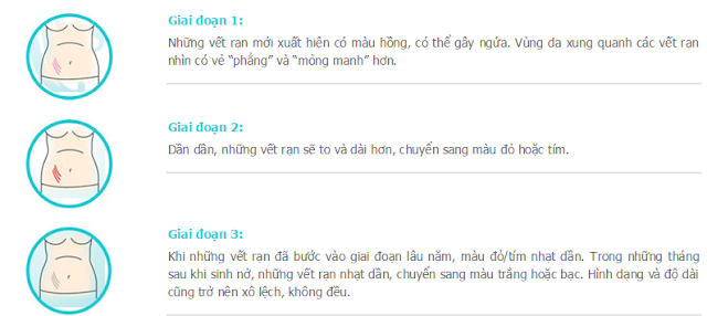 Trao đổi cùng lương y Việt Nga về chủ đề rạn da sau sinh