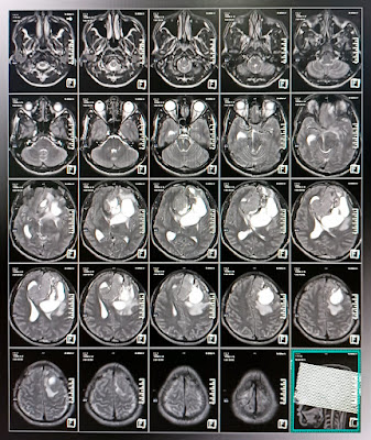 MRI of Brain with contrast & epilepsy protocol 