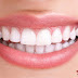 6 Benefit of Cleaner Smile Teeth Whitening Kit