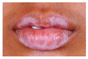 Mucosal Vitiligo