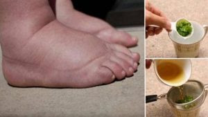 Solve The Problem With Swollen Legs Overnight With This Tea, It Really Works!