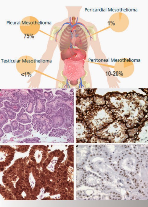 http://www.moreaboutmesothelioma.com/