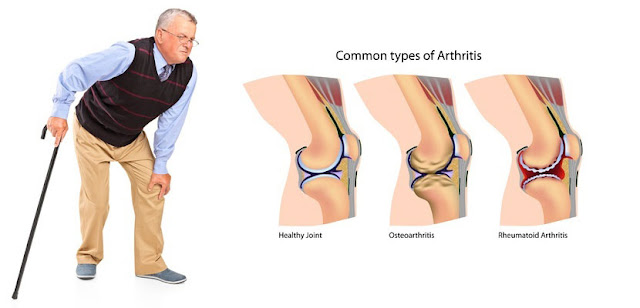 joint arthritis