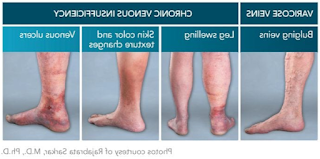 chronic venous insufficiency treatments, diagnosis and symptoms in children and adolescents