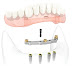 Phương pháp cấy ghép implant có đặc điểm gì?