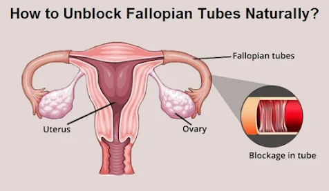 How to Unblock Fallopian Tubes Naturally