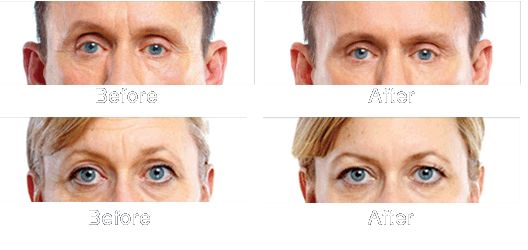 Before And After Botox Images. patients efore and after