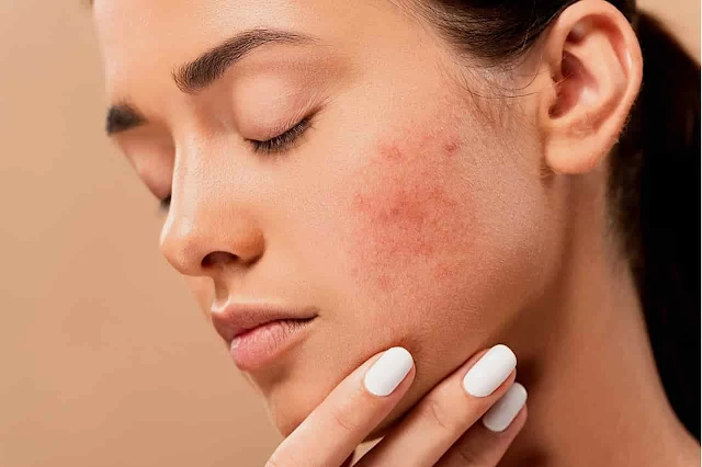 get rid of pimples overnight in 3 steps.