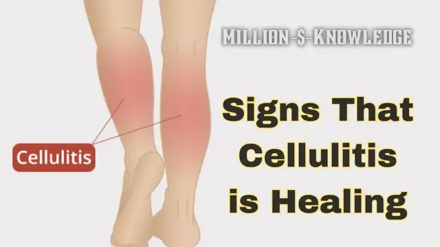 What are the signs that cellulitis is healing