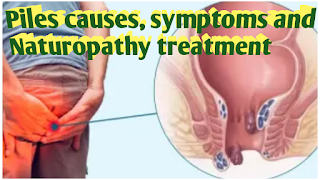Piles causes, symptoms and treatment , Symptoms of piles, Causes of piles, Naturopathy treatment of piles, Stress management.