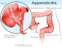 Appendicitis