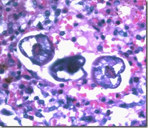 larva ascaris lumbricoides di jaringan paru