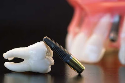 Trồng răng sứ nguyên hàm bằng cấy ghép implant