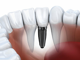 Cấy răng Implant