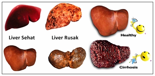 Cara Mengobati Penyakit Liver Secara Herbal Yang Sudah Parah