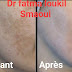 LE MELASMA