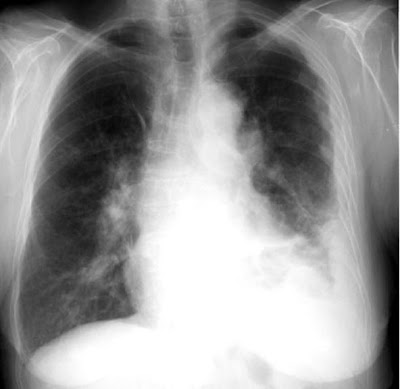 Precisely Mesothelioma: Mesothelioma Lawyer Lung X ray Histology CXR 