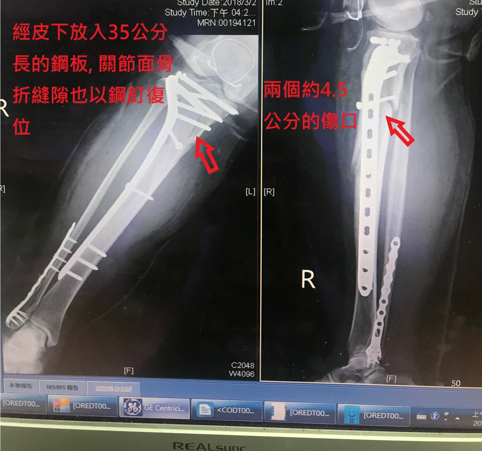 骨科李宜軒醫師 脛骨平台骨折tibia Plateau Fracture 脛骨近端骨折proximal Tibia Fracture