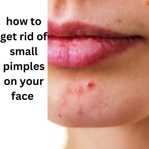  How to get rid of small pimples on your face in one week with aloe vera 