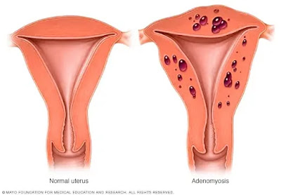 Adenomysis