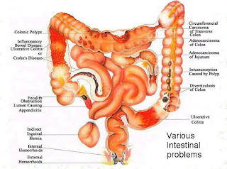 Kesehatan Usus, Ini Tips Herbal Menjaganya