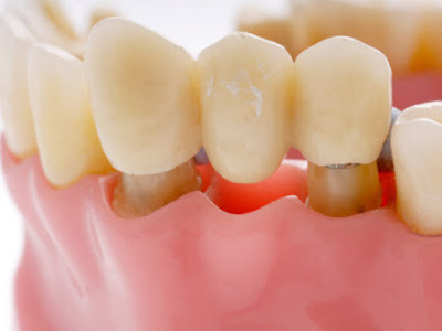 Trường hợp nào nên làm cầu răng sứ?