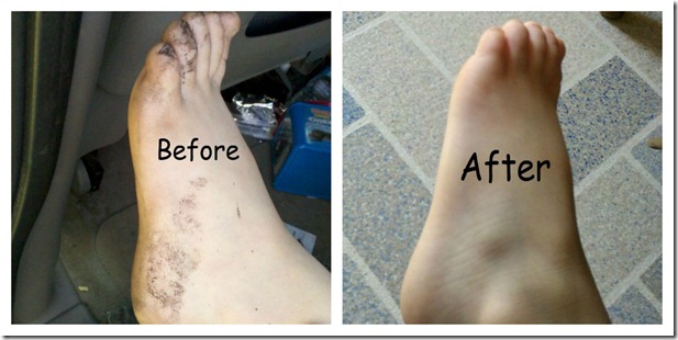 FootBeforeAfter2