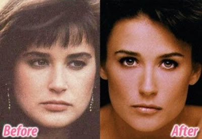 celebrity plastic surgery