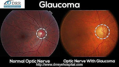 best glaucoma specialist  Hospital in chennai