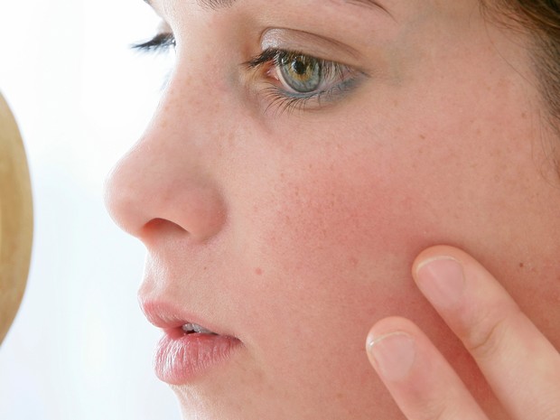 Ter acne pode ser sinal de pele mais jovem no futuro, diz estudo Ter acne pode ser sinal de pele mais jovem no futuro, diz estudo