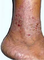 Obat kulit bersisik dan gatal di bagain kaki