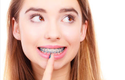  Quy trình niềng răng bị móm hiệu quả cao
