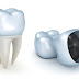 Làm răng sứ titan giá bao nhiêu tiền ?