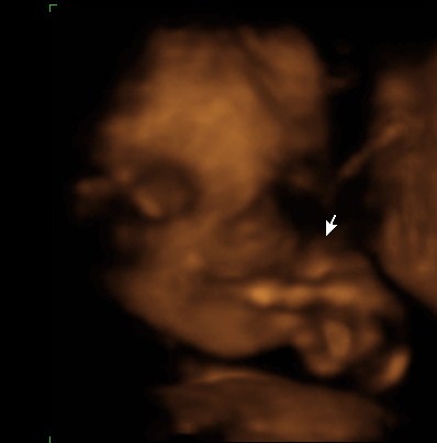 3d ultrasound 20 weeks pregnant. 3d ultrasound 20 weeks boy. 26