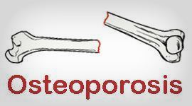 http://www.medkes.com/2014/06/manfaat-olahraga-untuk-penderita-osteoporosis.html