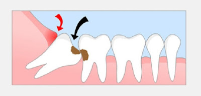 Răng khôn có nguy hiểm không?