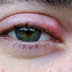 Bintitan: Mengenal, Mengobati, dan Mencegah Infeksi pada Kelopak Mata