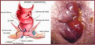 obat wasir setadium 4