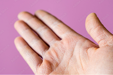 Cracks on Fingers: Effective Tips for Healing and Prevention