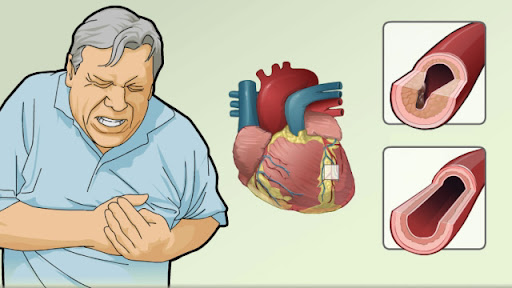 WHAT IS ANGINA? IS ANGINA DANGEROUS? CAUSES, SYMPTOMS, TYPES OF ANGINA, AIS ANGINA HEREDITARY? UNSTABLE ANGINA, DIAGNOSIS, TREATMENT