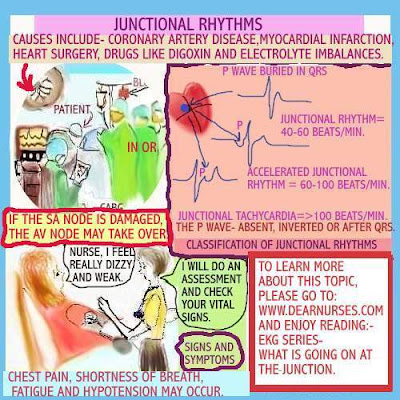 ACCELERATED JUNCTIONAL RHYTHM