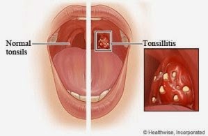 tonsils stones - tonsillitihs