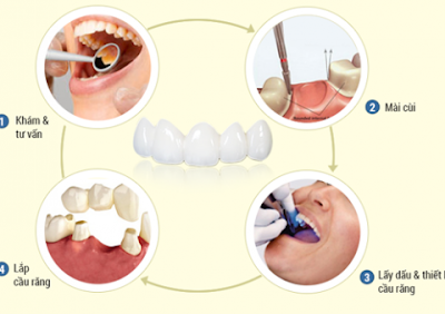 Quy trình làm cầu răng sứ tại nha khoa