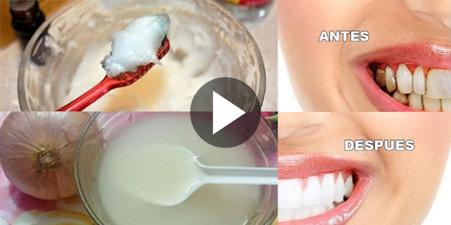 This Mixture Whitens Your Teeth, Eliminates Bad Brath, Tartar And Plaque