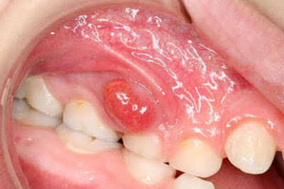 Chân răng sâu bị sưng có nguy hiểm không?
