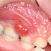 Tại sao chân răng sâu bị sưng
