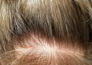 Tafsir dan Arti Mimpi Kutu Rambut
