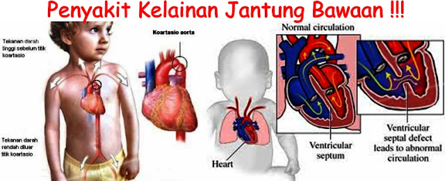 Penyebab Penyakit Jantung Bawaan ( PJB ) serta Pengobatannya