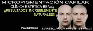 Micropigmentación capilar Cádiz. CLÍNICA ESTÉTICA MARBELLA: Te ofrecemos los mejores especialistas para tatuaje capilar Cádiz