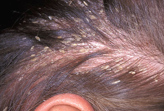 GATAL Jamur dikepala yang dapat menyebabkaN kulit kepala berkerak dan mengelupas